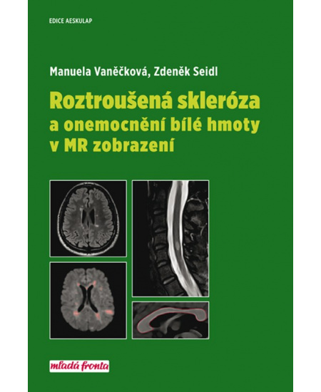 Roztroušená skleróza a onemocnění bílé hmoty v MR zobrazení