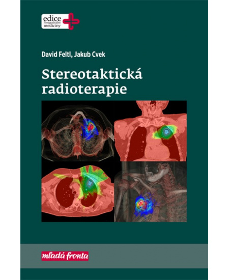 Stereotaktická radioterapie