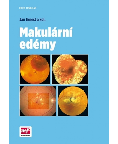 Makulární edémy