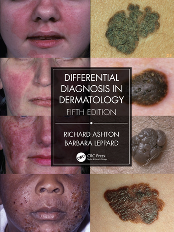 Differential Diagnosis in Dermatology