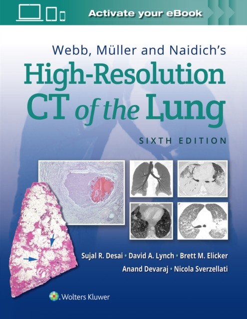 Webb, Muller and Naidich´s High-Resolution CT of the Lung Wolters Kluwer Health